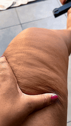 Tecnologia móvel do programa Desafio Adeus Lipedema